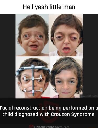 Hell yeah little man Facial reconstruction being performed on child diagnosed with Crouzon Syndrome
