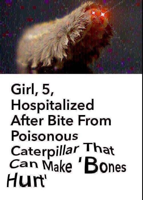 Girl 5 Hospitalized After Bite From Poisonous Caterplllaf That Can Make Bones unt