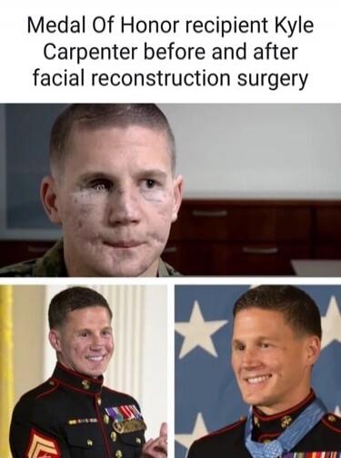 Medal Of Honor recipient [redacted] before and after facial reconstruction surgery