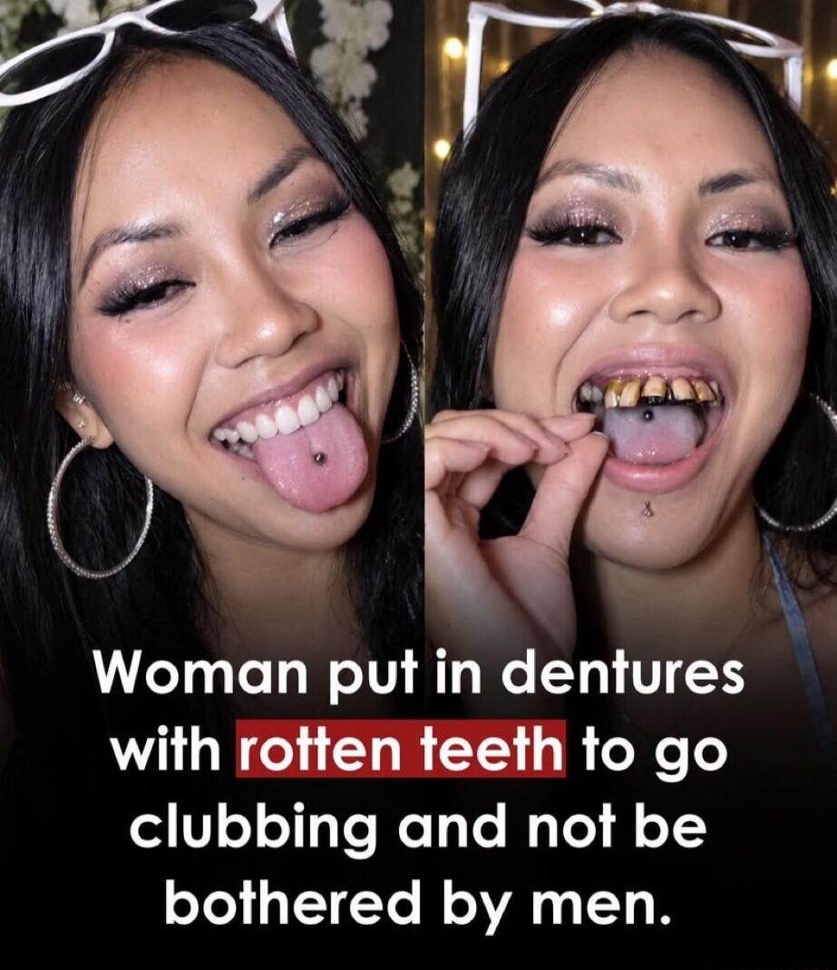 Woman put in dentures with rotten teeth to go clubbing and not be bothered by men.