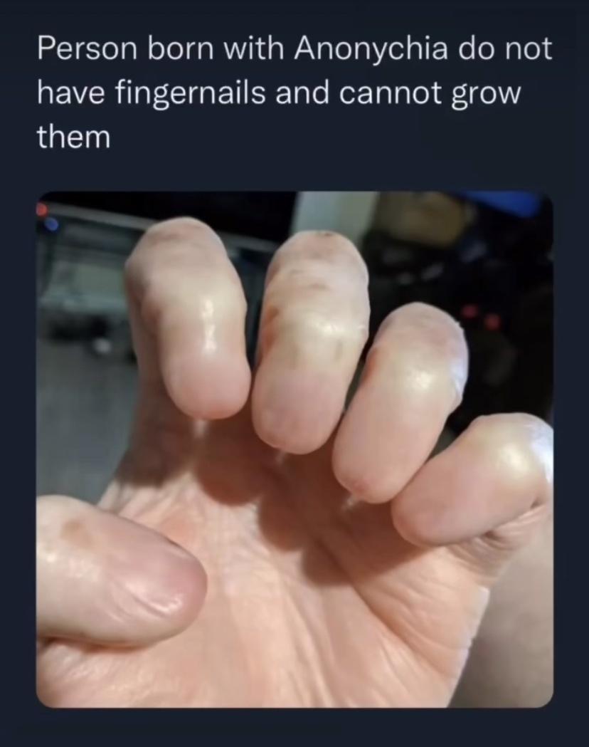 Person born with Anonychia do not QEVERIGECIGEIRER Rl e them