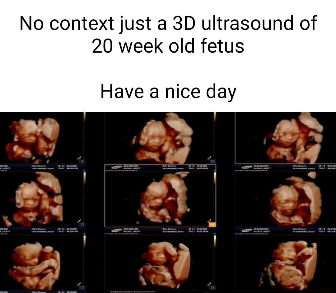 No context just a 3D ultrasound of 20 week old fetus Have a nice day S