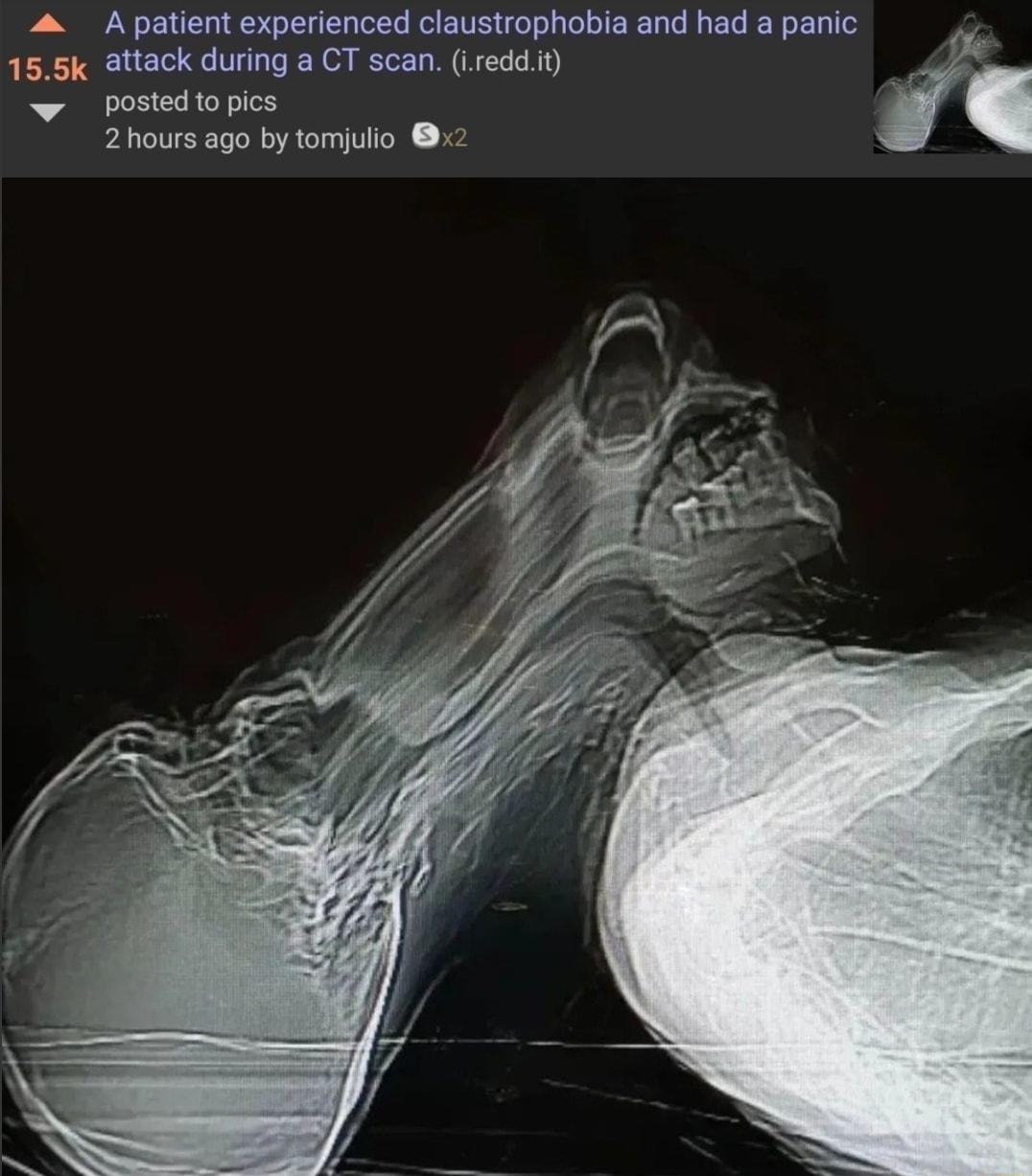 4 A patient experienced claustrophobia and had a panic 155k attack during a CT scan Lreddit postedtopics 2hours ago by tomjulio 2