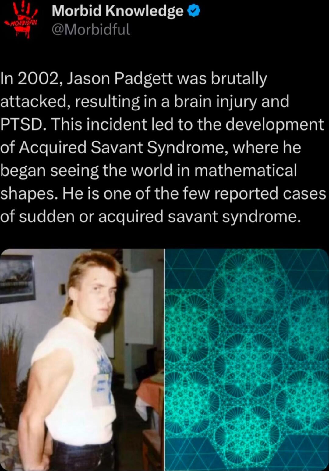 Morbid LGIWELESS eTolleV8 In 2002 Jason Padgett was brutally attacked resulting in a brain injury and PTSD This incident led to the development of Acquired Savant Syndrome where he began seeing the world in mathematical shapes He is one of the few reported cases STV o TN T IoTe VIIETo IR WE T SV e e T