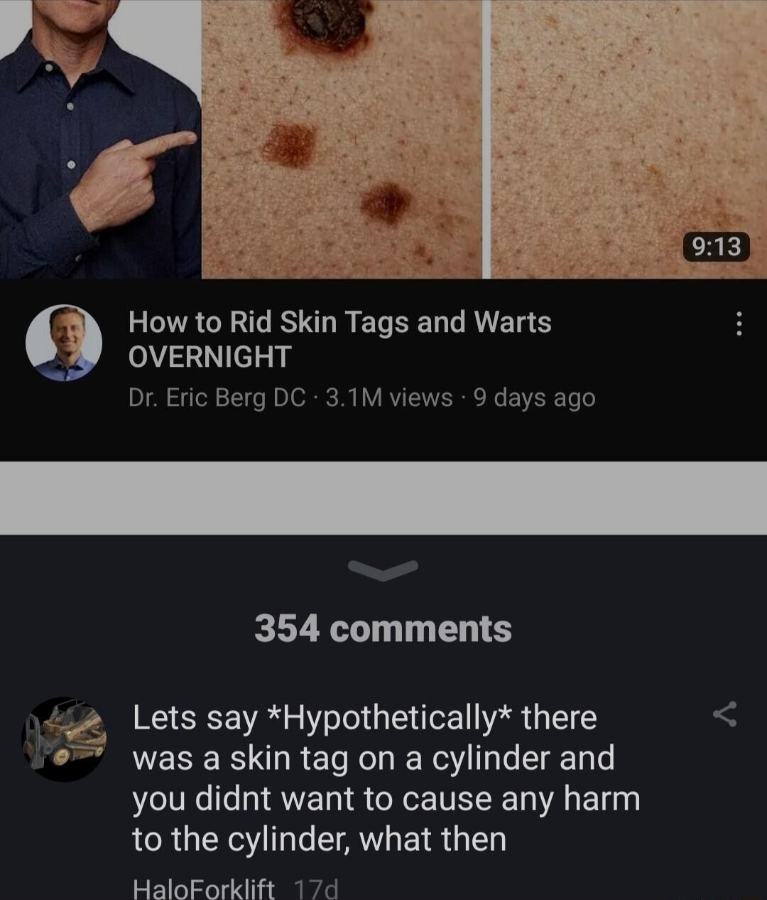 How to Rid Skin Tags and Warts OVERNIGHT Dr Eric Berg DC 31M views 9 days ago 354 comments Lets say Hypothetically there was a skin tag on a cylinder and you didnt want to cause any harm to the cylinder what then HaloForklift 17d