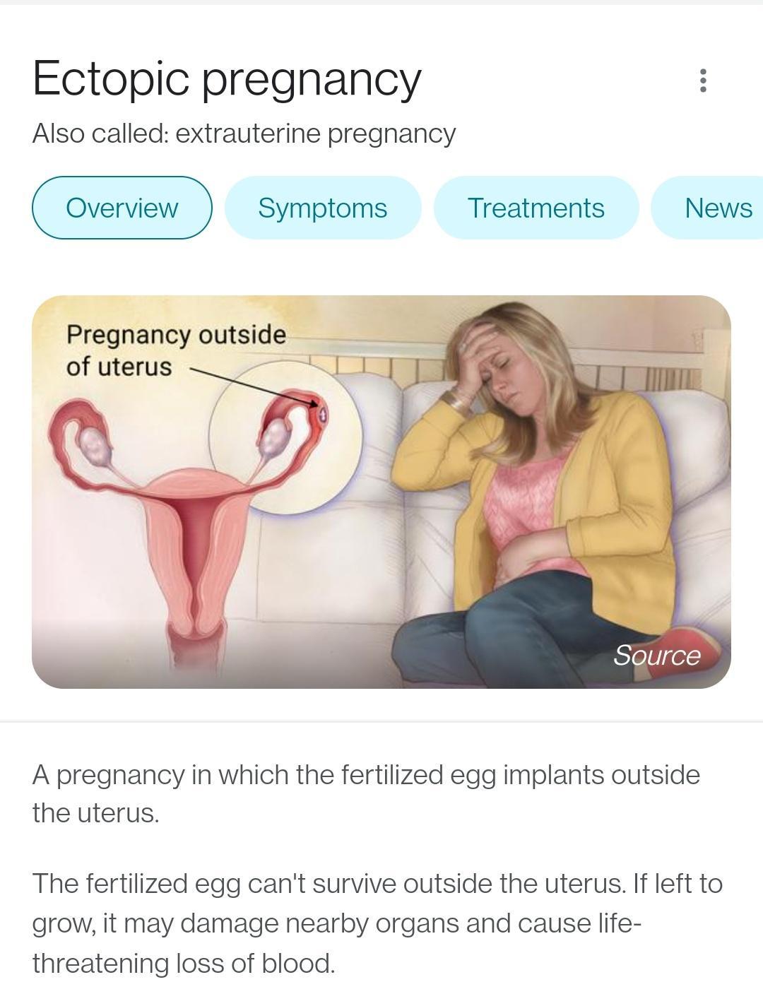 Ectopic pregnancy Also called extrauterine pregnancy Symptoms Treatments News Pregnancy outside of uterus A pregnancy in which the fertilized egg implants outside the uterus The fertilized egg cant survive outside the uterus If left to grow it may damage nearby organs and cause life threatening loss of blood