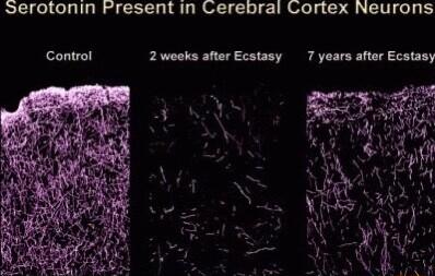 Serotonin Fresent in Cerebral Cortex Neurons Control 2weeks after Ecstasy 7 years after Ecstasy