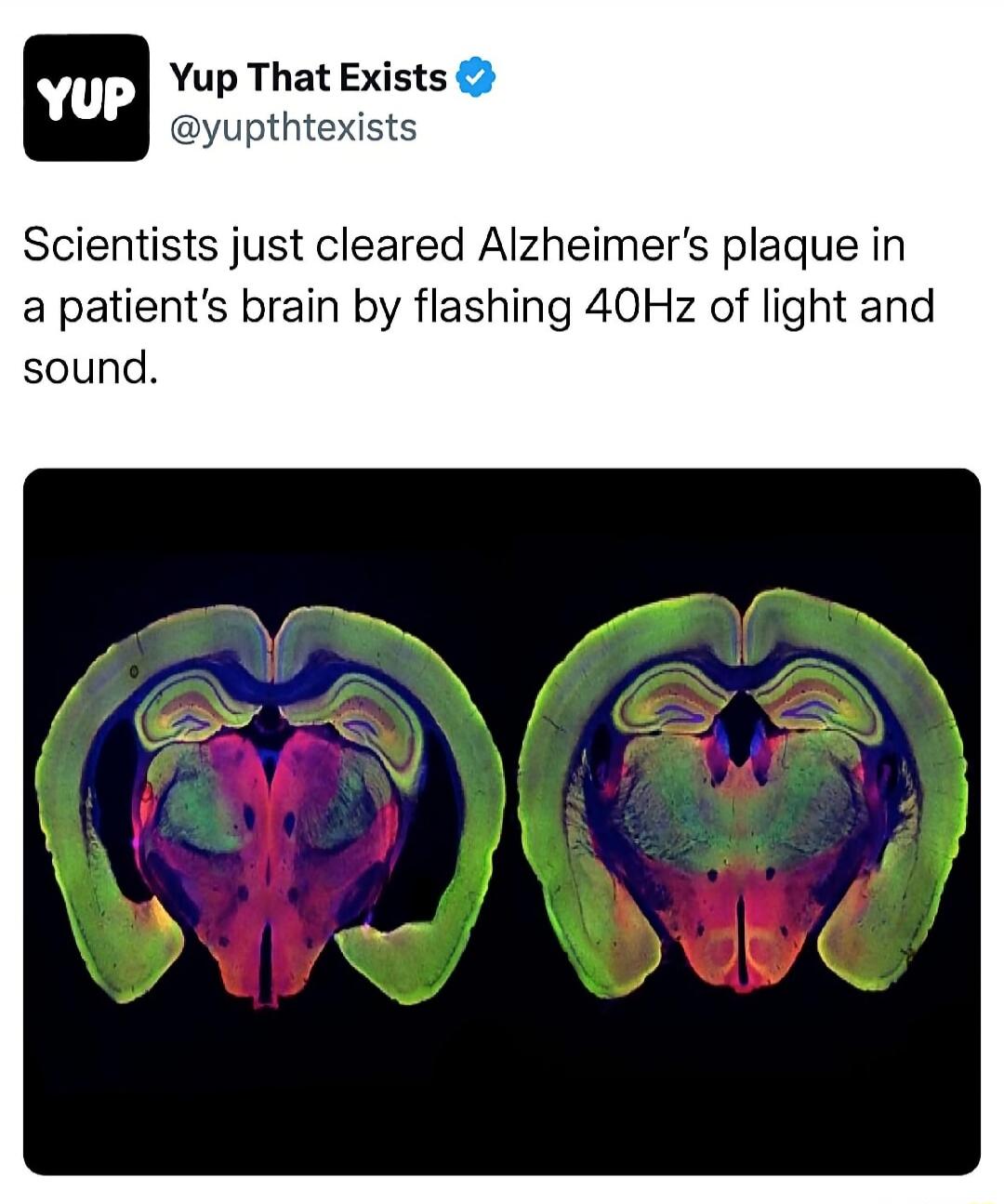 Yup That Exists @yupthtexists Scientists just cleared Alzheimer's plaque in a patient's brain by flashing 40Hz of light and sound.