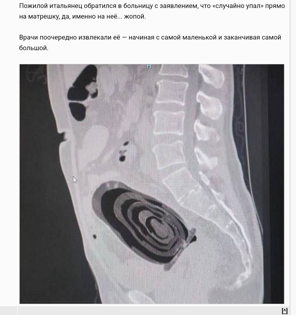 Пожилой ит пьянец обратился в больницу на матрешку даименно на неёжотой злением что случайно упал прямо Врачи поочередко извлекали е8 начиная с самой маленькой и заканчивая самой большой