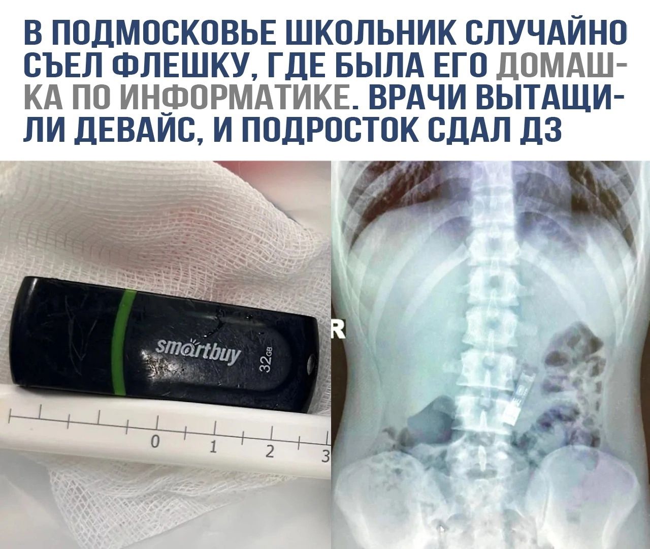 В ПОДМОСКОВЬЕ ШКОЛЬНИК СЛУЧАЙНО СЪЕЛ ФЛЕШКУ ГДЕ БЫЛА ЕГО ДОМАШ КА ПО ИНФОРМАТИКЕ ВРАЧИ ВЫТАЩИ ЛИ ДЕВАЙС И ПОДРОСТОК СДАЛ ДЗ р э
