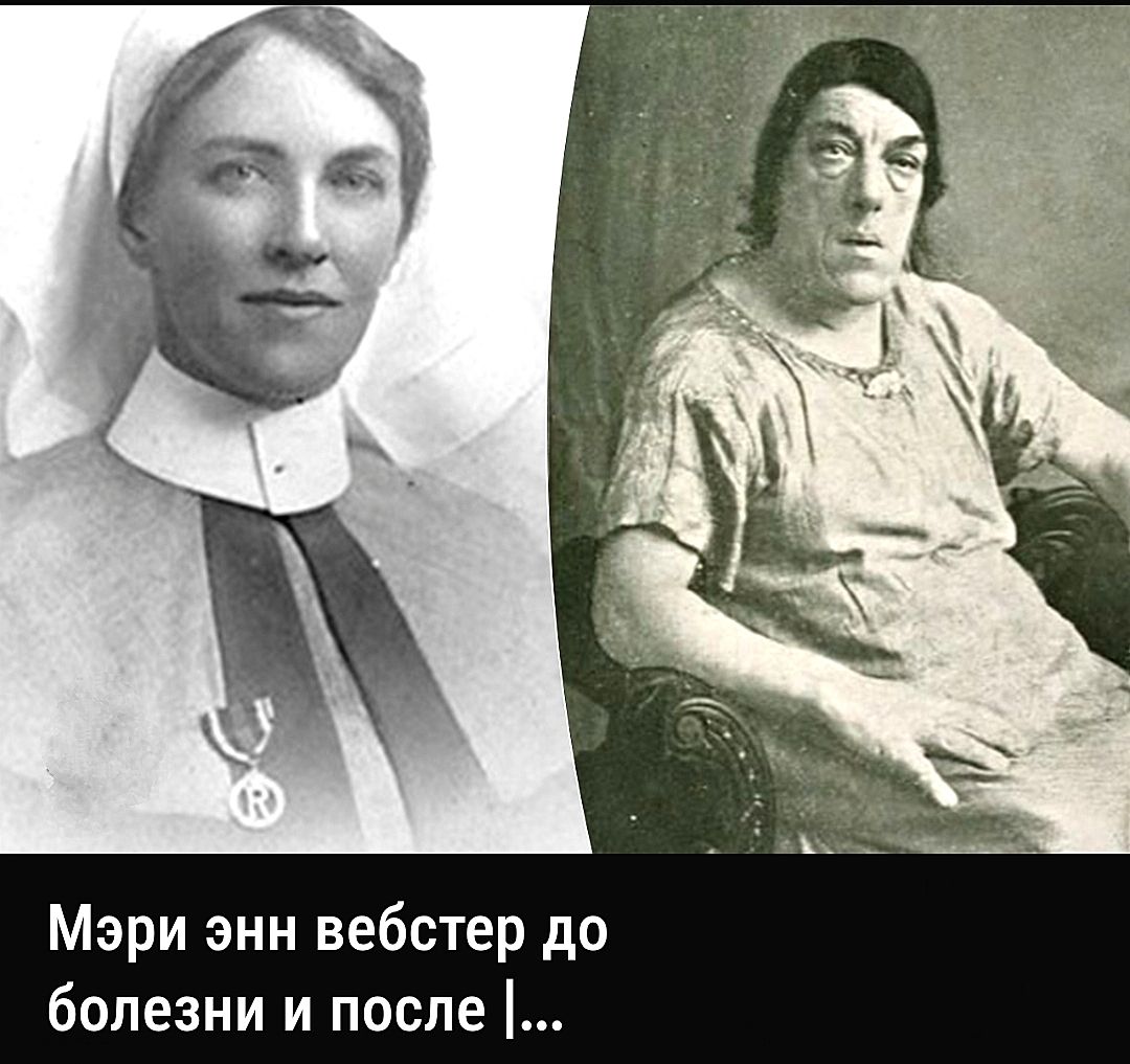 Мэри Энн вебстер до болезни и после