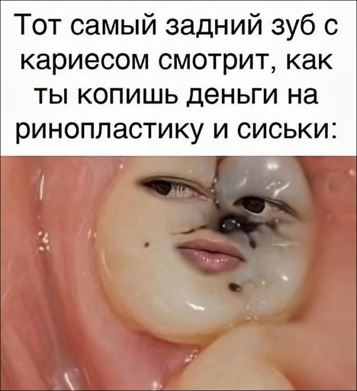 Тот самый задний зуб с кариесом смотрит, как ты копишь деньги на ринопластику и сиськи:
