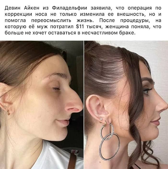 Девин Айкен из Филадельфии заявила, что операция по коррекции носа не только изменила ее внешность, но и помогла переосмыслить жизнь. После procedure, на которую её муж потратил $11 тыс, женщина поняла, что больше не хочет оставаться в несчастливом браке.