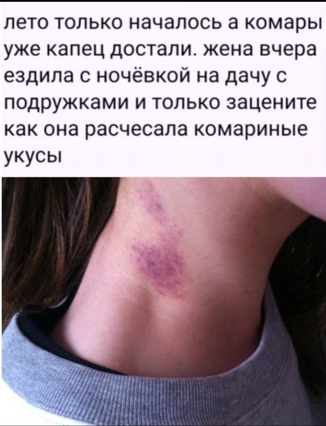 ЛЕТО ТОЛЬКО НАЧАЛОСЬ А КОМАРЫ УЖЕ КАПЕЦ ДОСТАЛИ. ЖЕНА ВЧЕРА ЕЗДИЛА С НОЧЁВКОЙ НА ДАЧУ С ПОДРУЖКАМИ И ТОЛЬКО ЗАЦЕНИТЕ КАК ОНА РАСЧЕСАЛА КОМАРИНЫЕ УКУСЫ