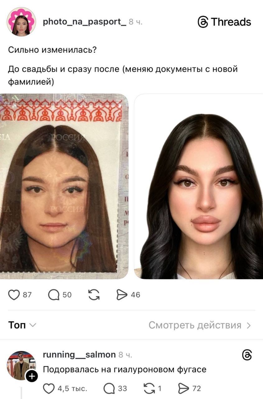 Сильно изменилась? До свадьбы и сразу после (меняю документы с новой фамилией) Подорвалась на гиалуроновом фугасе