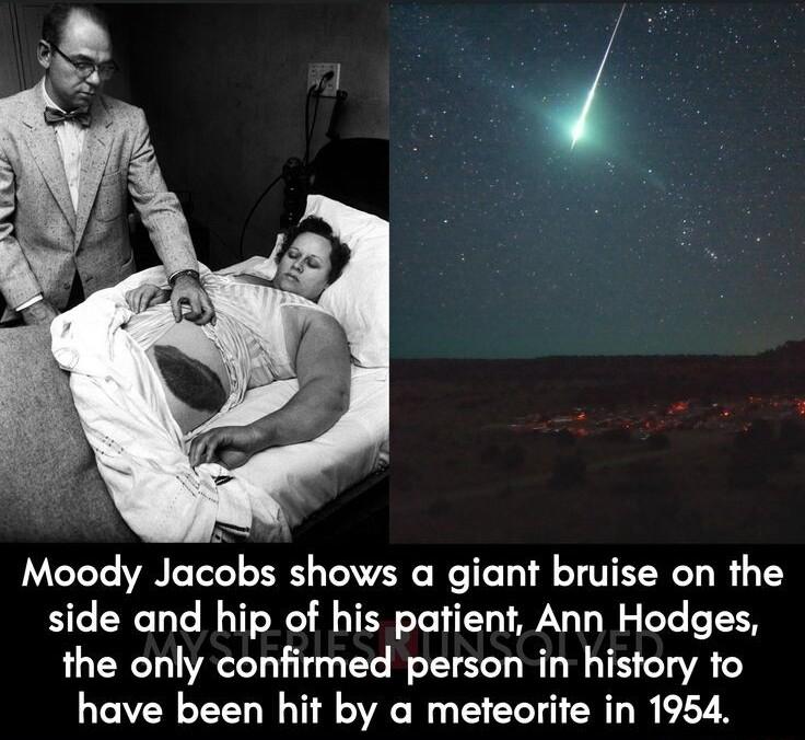 Moody Jacobs shows a giant bruise on the side and hip of his patient Ann Hodges the only confirmed person in history to have been hit by a meteorite in 1954