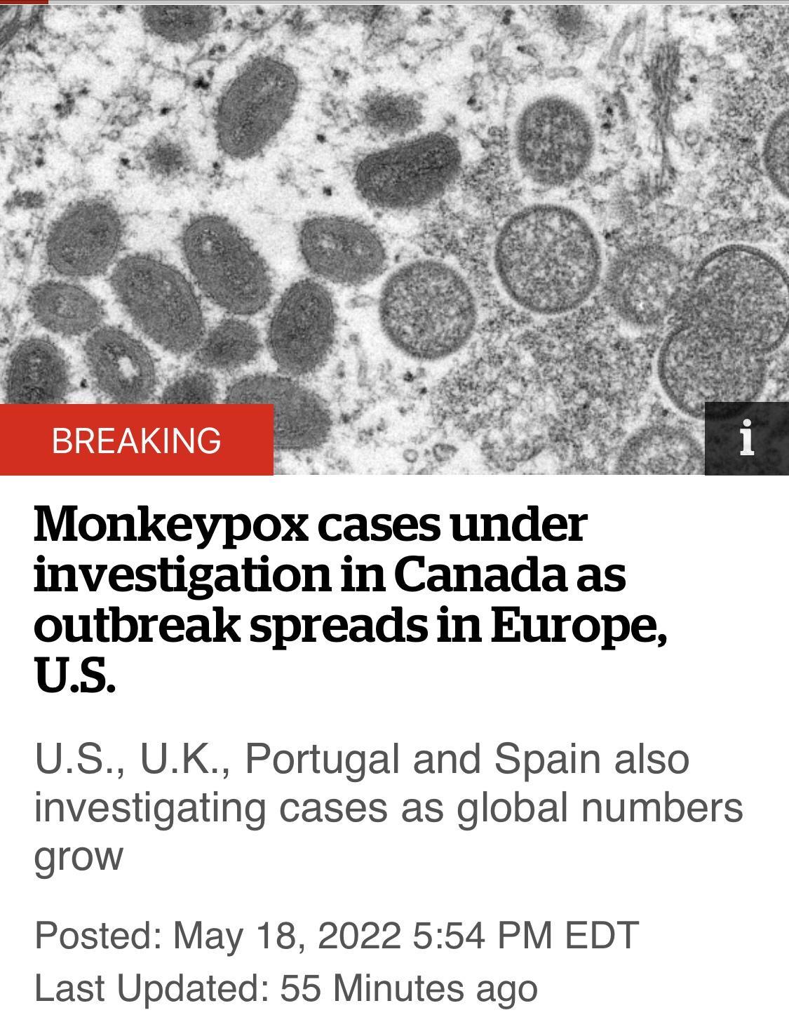 e AN i Monkeypox cases under investigation in Canada as outbreak spreads in Europe US US UK Portugal and Spain also investigating cases as global numbers grow Posted May 18 2022 554 PM EDT Last Updated 55 Minutes ago