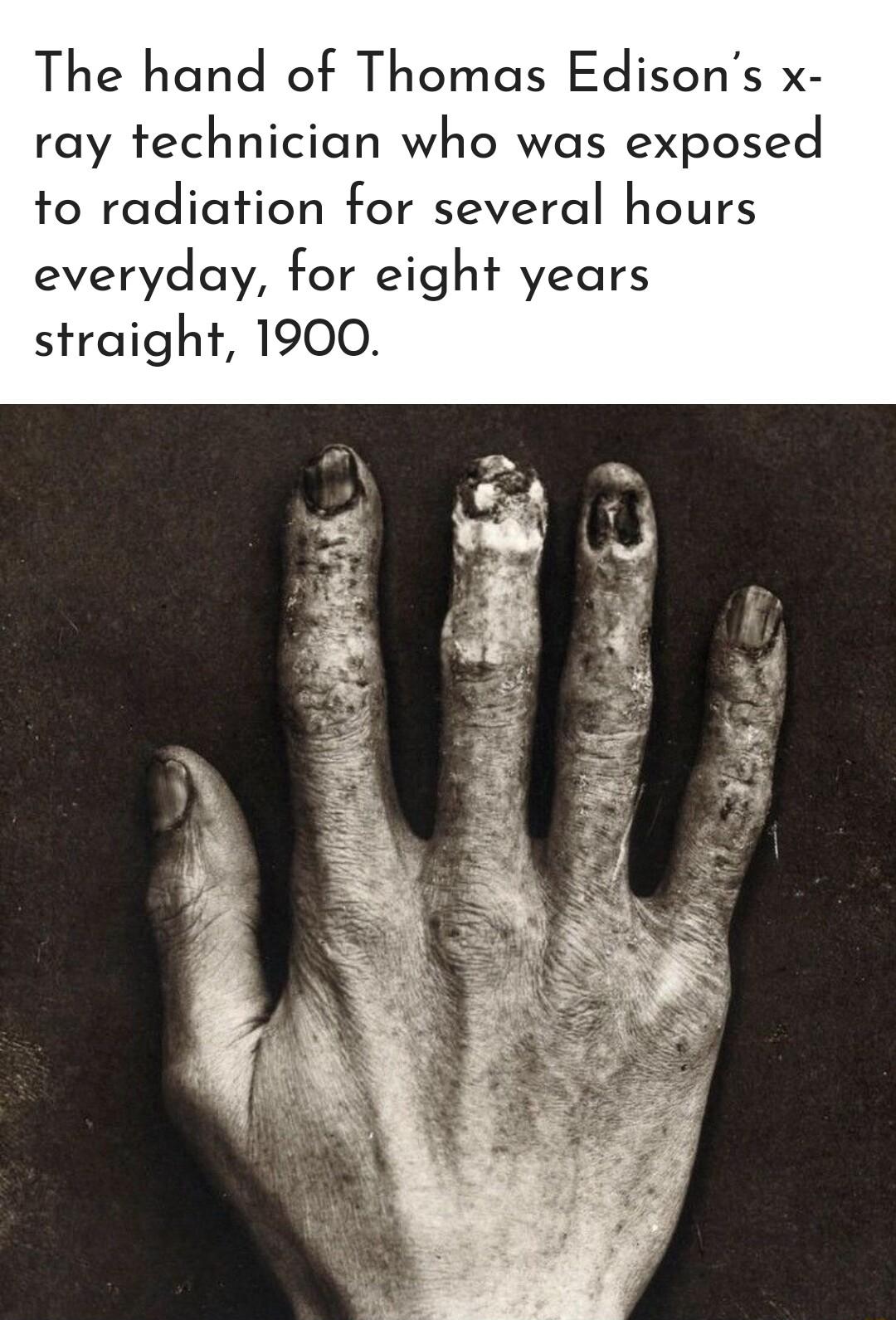 The hand of Thomas Edisons x ray technician who was exposed to radiation for several hours everyday for eight years straight 1900