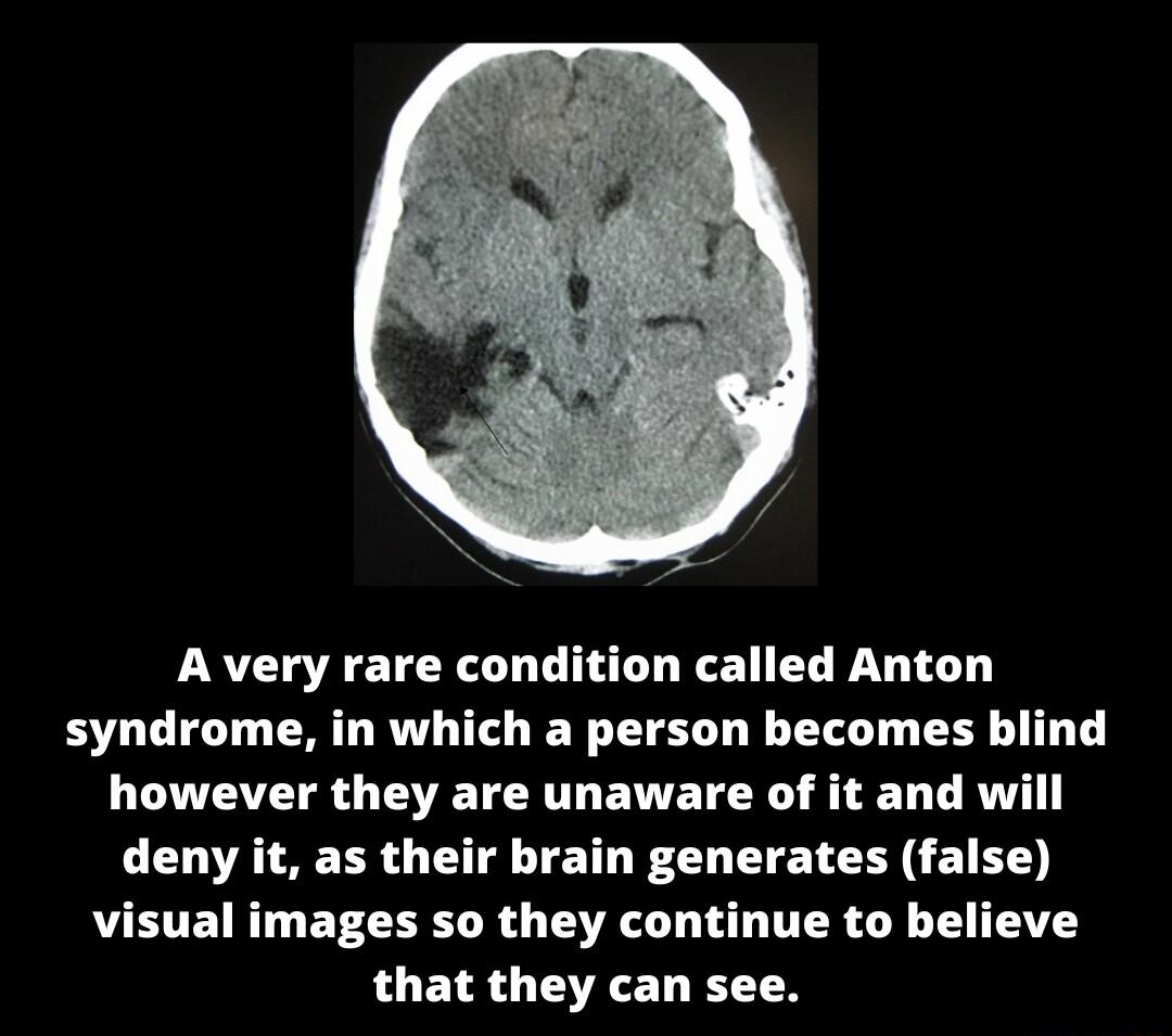 A very rare condition called Anton syndrome in which a person becomes blind however they are unaware of it and will deny it as their brain generates false visual images so they continue to believe that they can see
