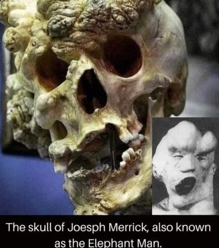The skull of Joesph Merrick also known as the Elephant Man