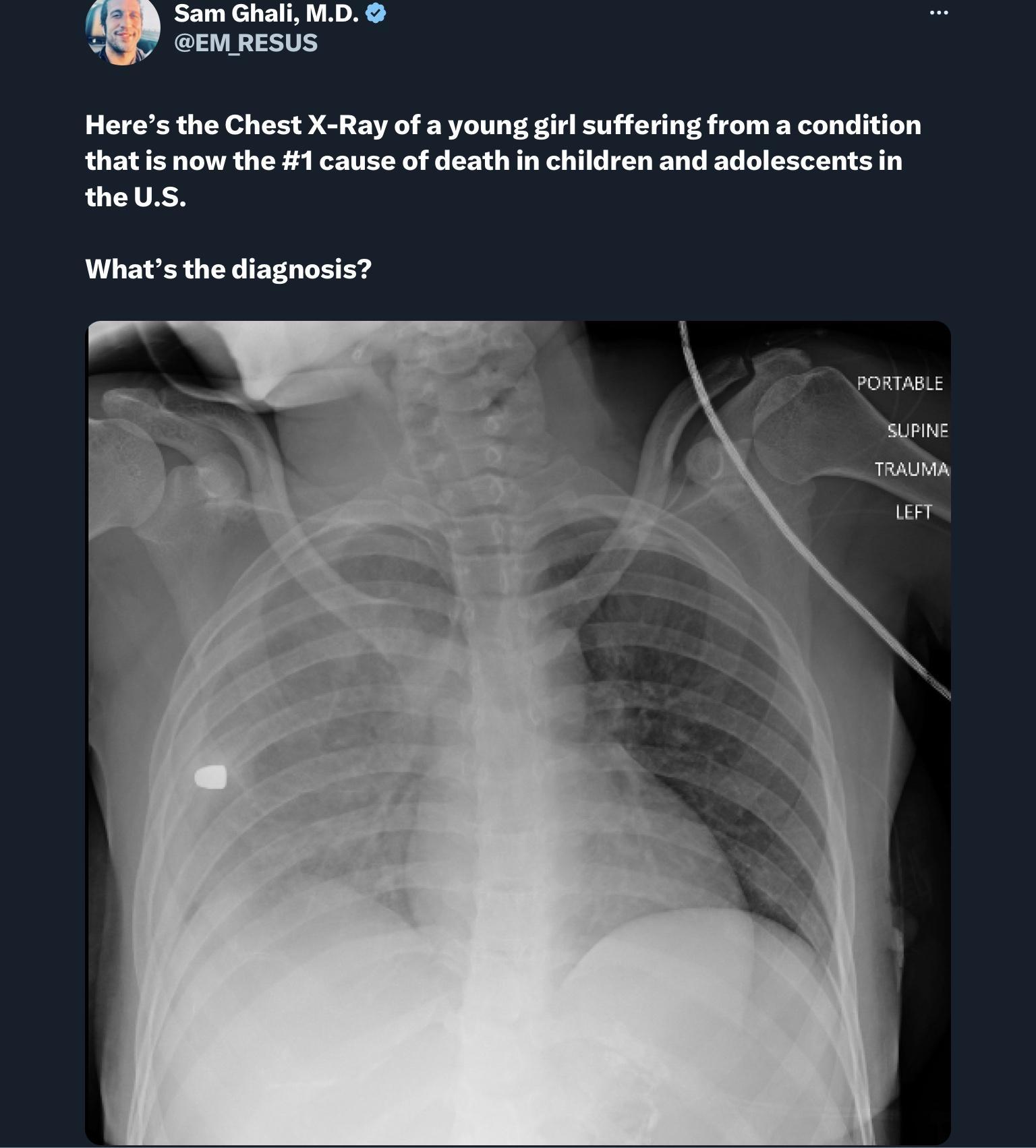 ke ShAR 1901 GEMRESUS Heres the Chest X Ray of a young girl suffering from a condition thatis now the 1 cause of death in children and adolescents in ONTEN Whats the diagnosis