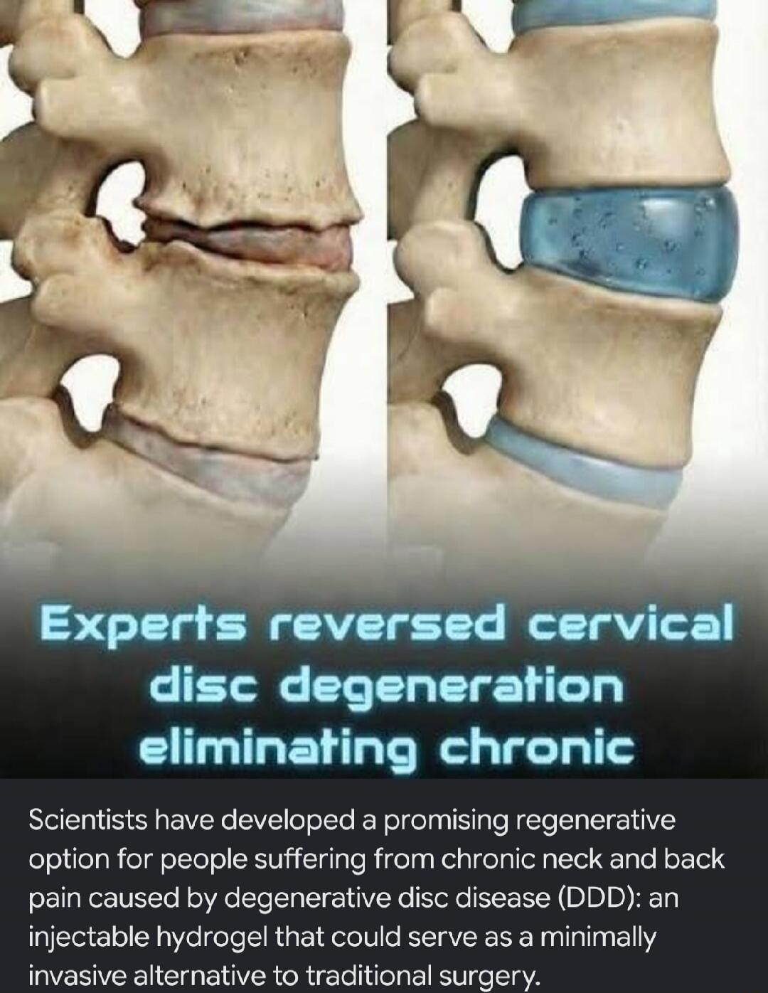 Experts reversed cervical disc degeneration eliminating chronic. Scientists have developed a promising regenerative option for people suffering from chronic neck and back pain caused by degenerative disc disease (DDD): an injectable hydrogel that could serve as a minimally invasive alternative to traditional surgery.