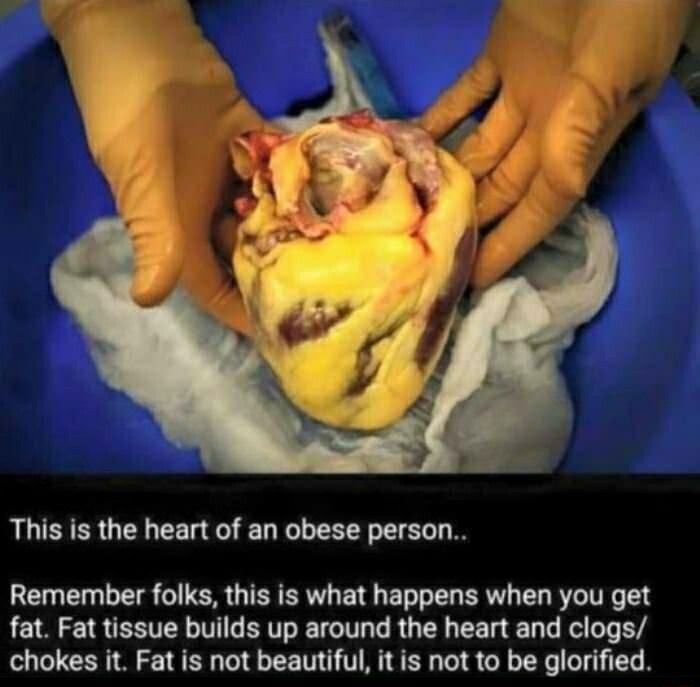 This is the heart of an obese person Remember folks this is what happens when you get fat Fat tissue builds up around the heart and clogs chokes it Fat is not beautiful it is not to be glorified