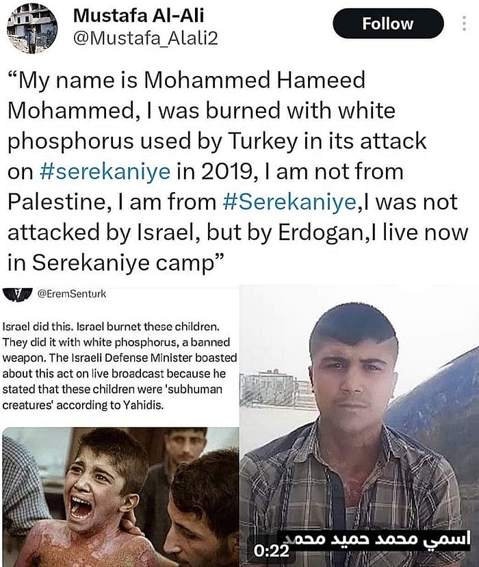 o My name is Mohammed Hameed Mohammed was burned with white phosphorus used by Turkey in its attack on serekaniye in 2019 am not from Palestine am from Serekaniyel was not attacked by Israel but by Erdogan live now in Serekaniye camp W osensen leraal i thi lsrael burnet thezo children They did it with white phosphorus abenned weapon The lsrael Defense Minister boasted about this act on ve broadcas