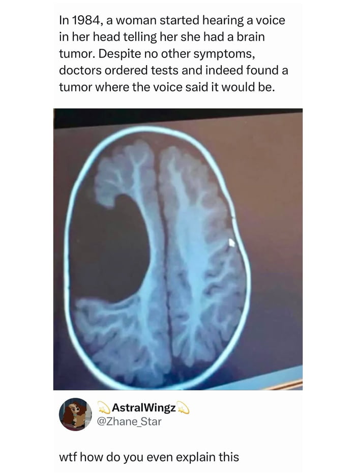 In 1984, a woman started hearing a voice in her head telling her she had a brain tumor. Despite no other symptoms, doctors ordered tests and indeed found a tumor where the voice said it would be.