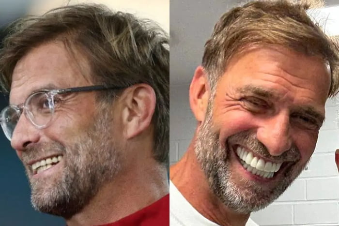 A split image showing Jürgen Klopp before and after a significant change in his teeth. On the left, he is seen with his natural teeth and glasses, smiling. On the right, he displays a much brighter, whiter smile, likely due to veneers, and is without glasses.