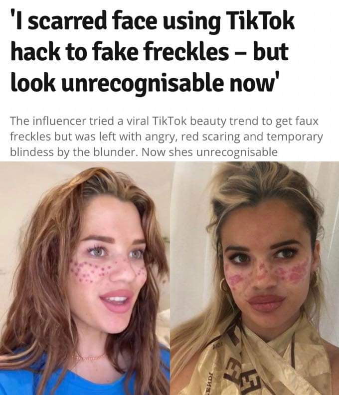 scarred face using TikTok hack to fake freckles but look unrecognisable now The influencer tried a viral TikTok beauty trend to get faux freckles but was left with angry red scaring and temporary blindess by the blunder Now shes unrecognisable