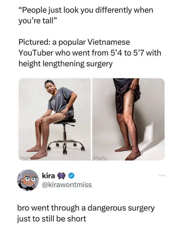 People just look you differently when youre tall Pictured a popular Vietnamese YouTuber who went from 54 to 57 with height lengthening surgery kira 9 S kirawontmiss bro went through a dangerous surgery just to still be short