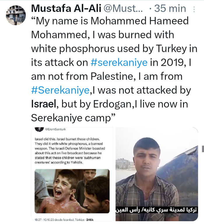 Mustafa Al Ali Must 35 min My name is Mohammed Hameed Mohammed was burned with white phosphorus used by Turkey in its attack on serekaniye in 2019 am not from Palestine I am from Serekaniyel was not attacked by Israel but by Erdogan I live now in Serekaniye camp