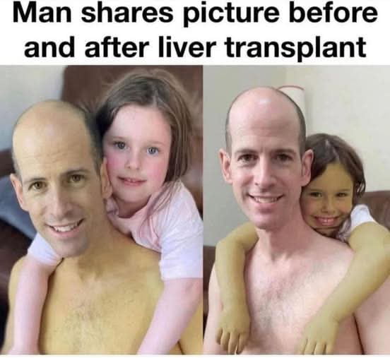 Man shares picture before and after liver transplant