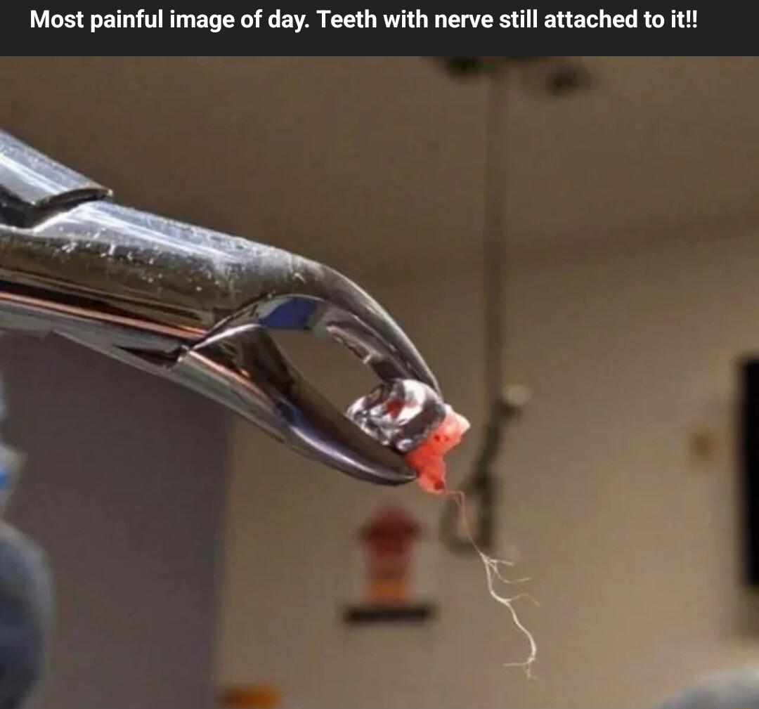 Most painful image of day Teeth with nerve still attached to it