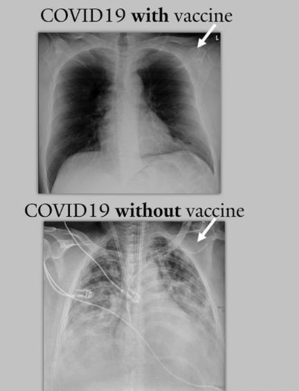 COVID19 with vaccine COVID19 without vaccine R S