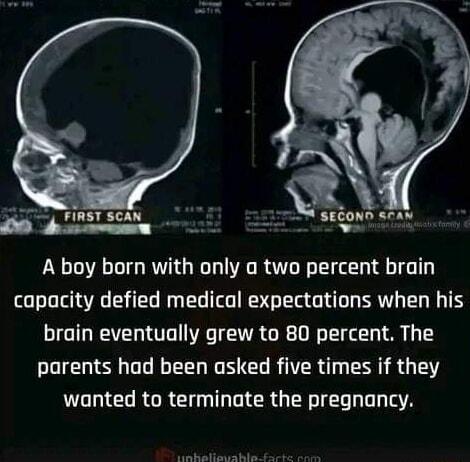 SECOND ran A boy born with only a two percent brain capacity defied medical expectations when his brain eventually grew to 80 percent The parents had been asked five times if they wanted to terminate the pregnancy e gy