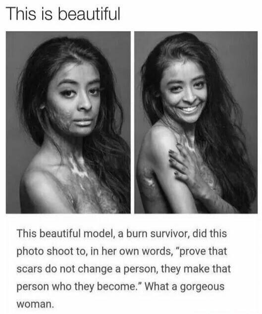 This is beautiful
[Left image] [Right image]
This beautiful model, a burn survivor, did this photo shoot to, in her own words, “prove that scars do not change a person, they make that person who they become.” What a gorgeous woman.