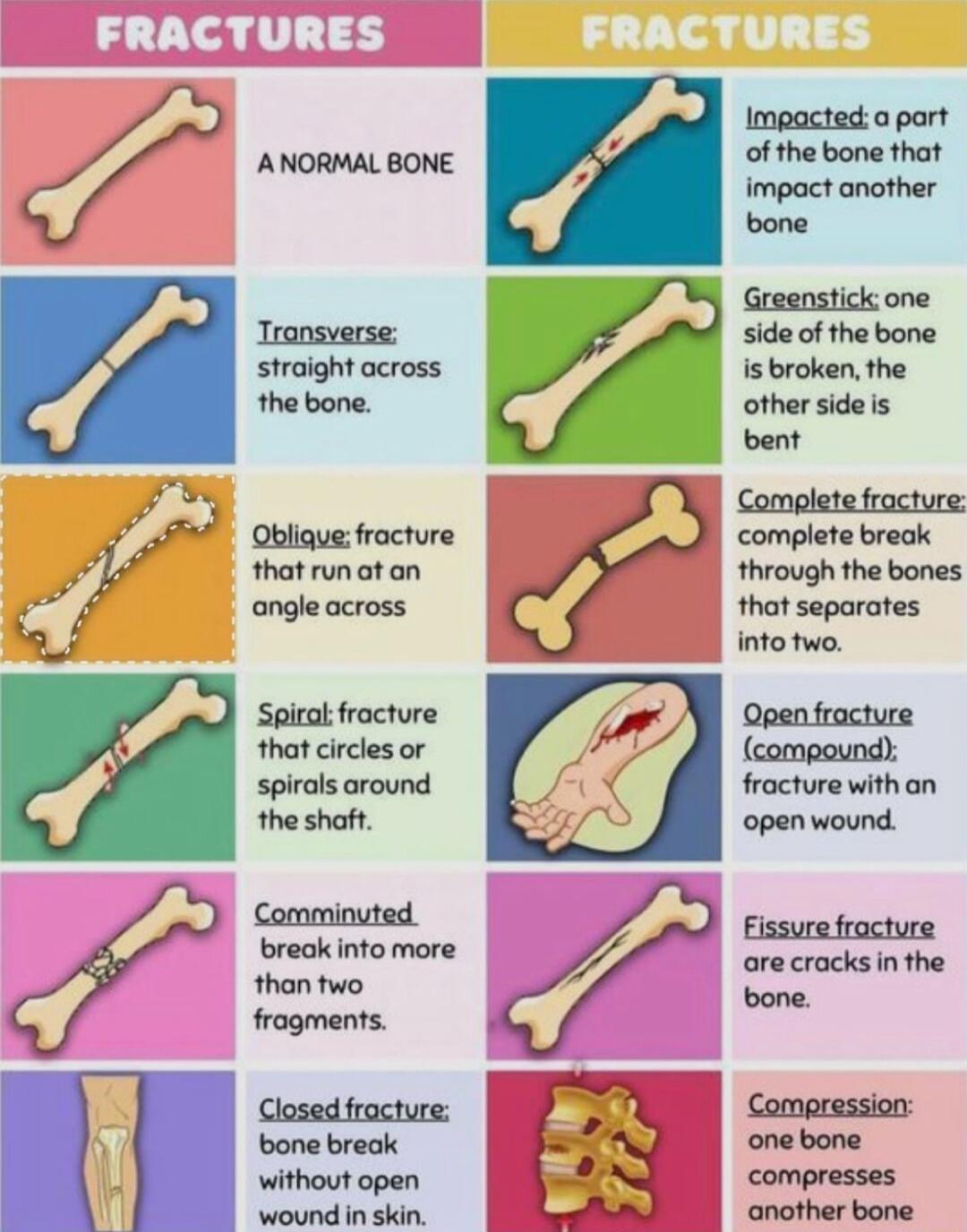 0 Impactedaport ANORMAL BONE of the bone that impact another bone Greenstick one side of the bone is broken the other sideis bent Complete fracture Oblique fracture complete break that run ot an through the bones ongle across that separates info two Spirak frocture that circles or spirals around the shaft Qpentracture compound fracture with an openwound Fissure fracture are cracks in the