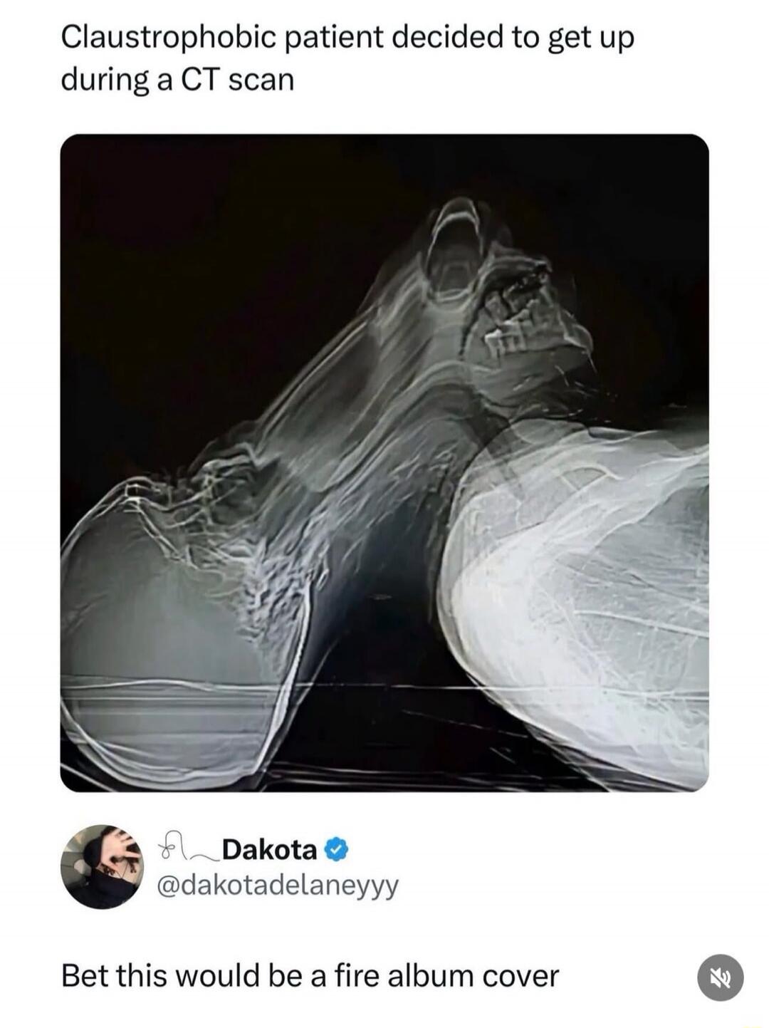 Claustrophobic patient decided to get up during a CT scan
Bet this would be a fire album cover