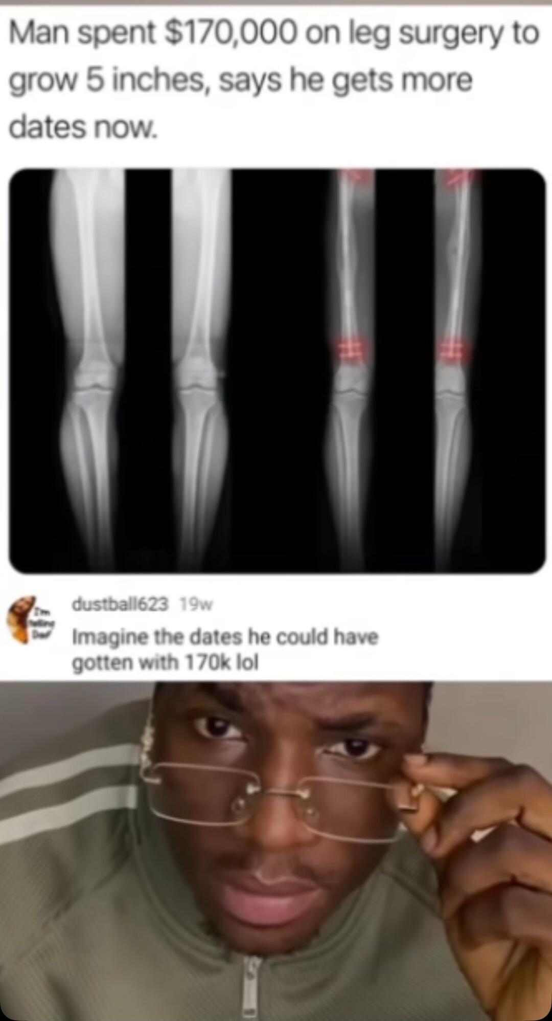 Man spe on leg surgery to grow 5 inches says he gets more datesr