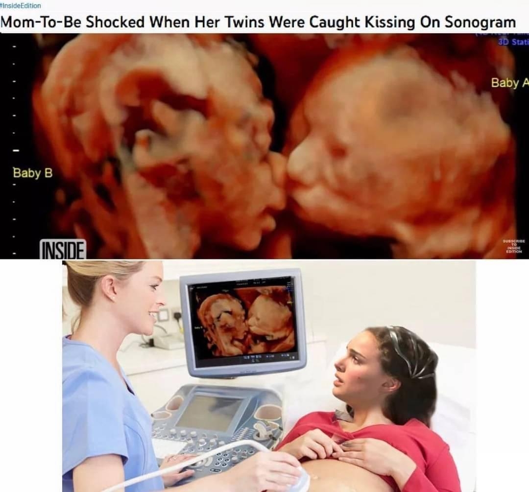 Mom To Be Shocked When Her Twins Were Caught Kissing On Sonogram