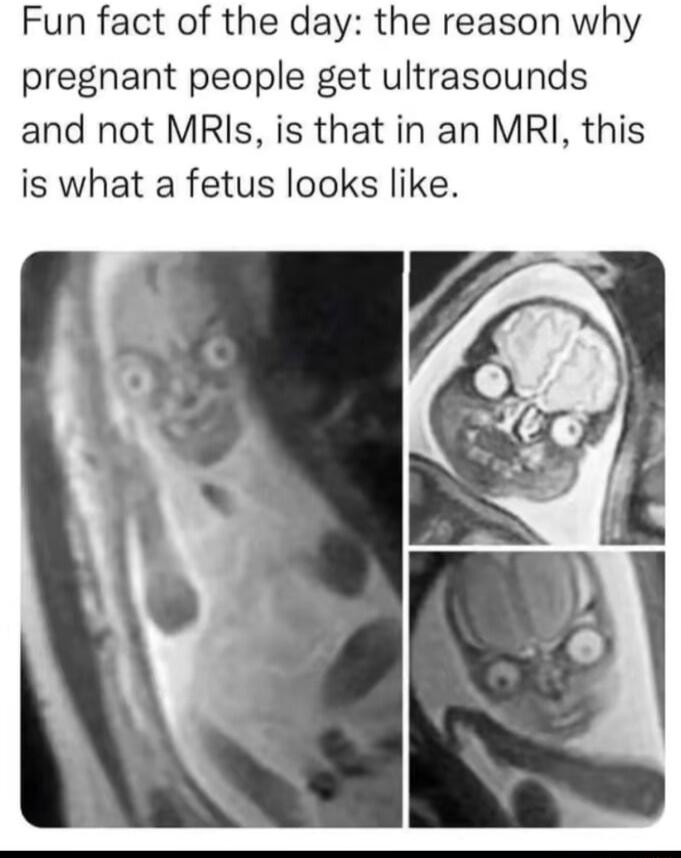 Fun fact of the day the reason why pregnant people get ultrasounds and not MRIs is that in an MRI this is what a fetus looks like