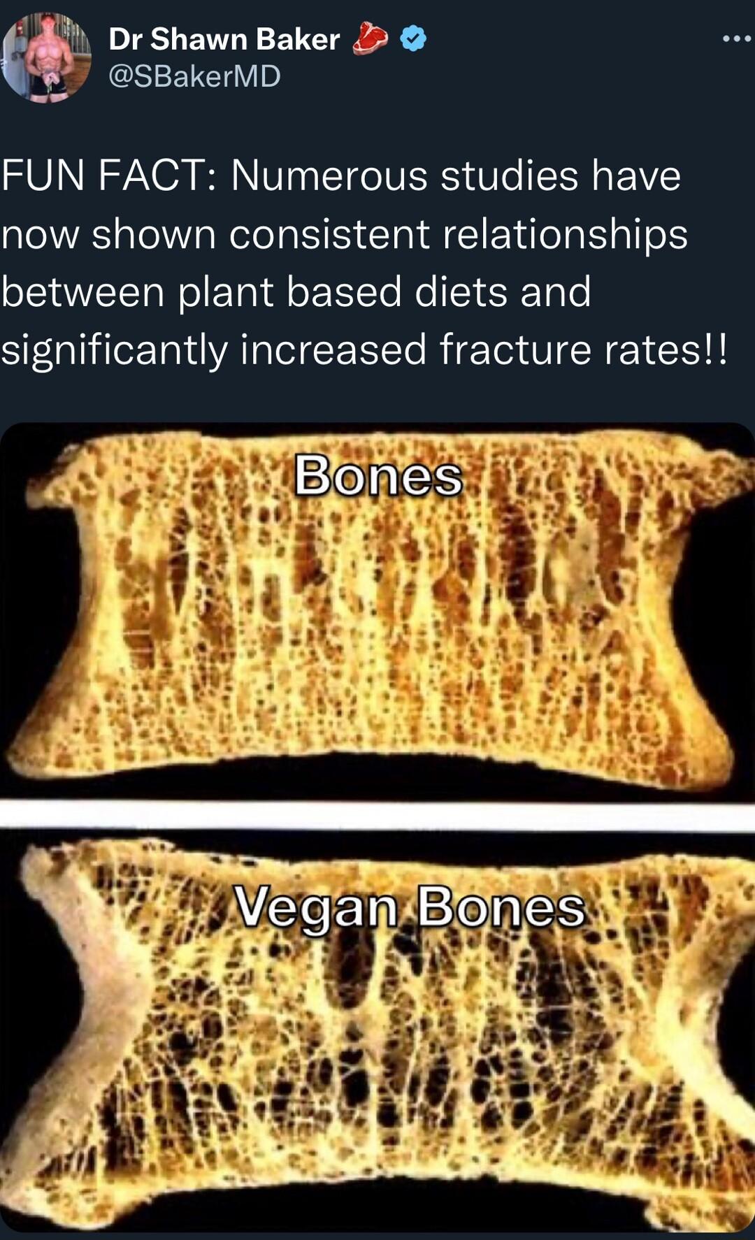 Dr Shawn Baker 2 SBakerMD FUN FACT Numerous studies have now shown consistent relationships between plant based diets and significantly increased fracture rates