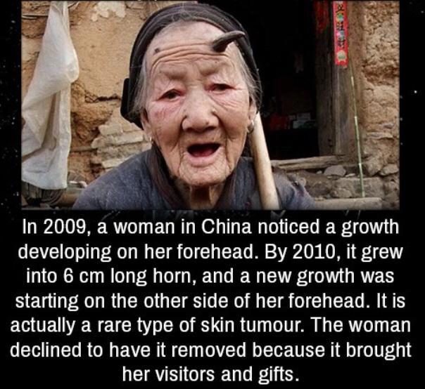 In 2009 a woman in China noticed a growth developing on her forehead By 2010 it grew into 6 cm long horn and a new growth was starting on the other side of her forehead Itis actually a rare type of skin tumour The woman declined to have it removed because it brought her visitors and gifts
