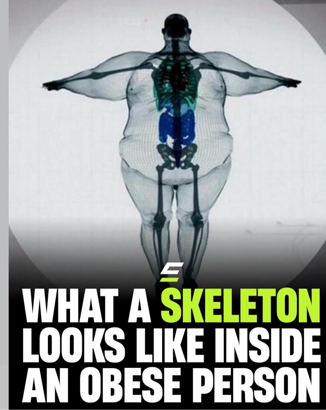 WHAT A SKELETON LOOKS LIKE INSIDE AN OBESE PERSON