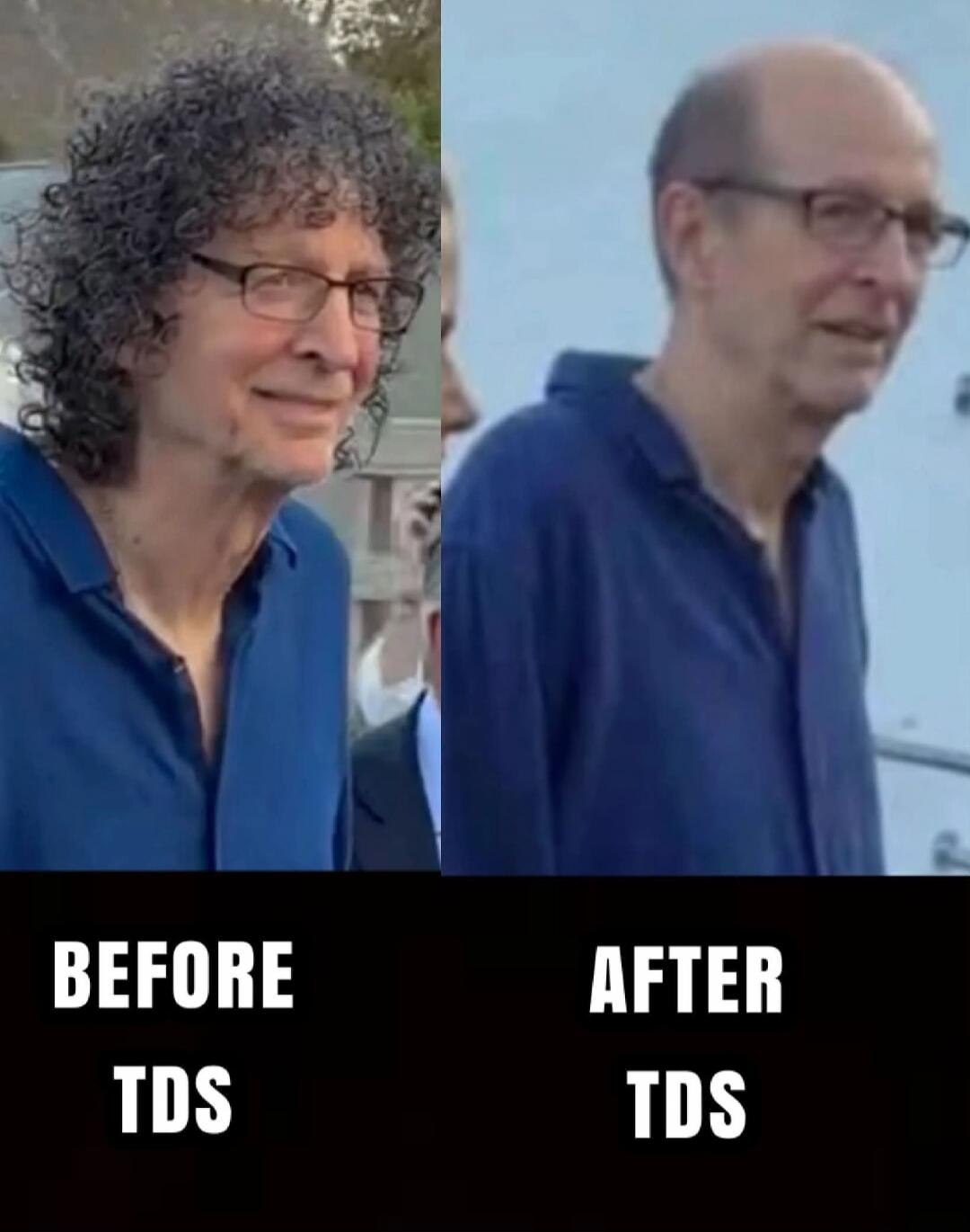 The image shows a man, widely recognized as Howard Stern, in a 'before and after' comparison. On the left, labeled 'BEFORE TDS', he has a full head of curly hair. On the right, labeled 'AFTER TDS', he appears bald. The meme implies a humorous connection between 'Trump Derangement Syndrome' (TDS) and hair loss.