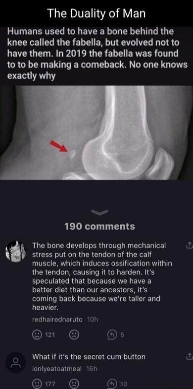 AL CEDIER R YED Humans used to have a bone behind the LOEEEE CU R ER LT ENIN R G IS G LEVER U MDA ERG TR ELEEREES G to to be making a comeback No one knows eI 190 comments The bone develops through mechanical ARGt i on i tercon ot cak muscle which induces ossification within the tendon causing it to harden Its speculated that because we have a better diet than our ancestors its coming back because