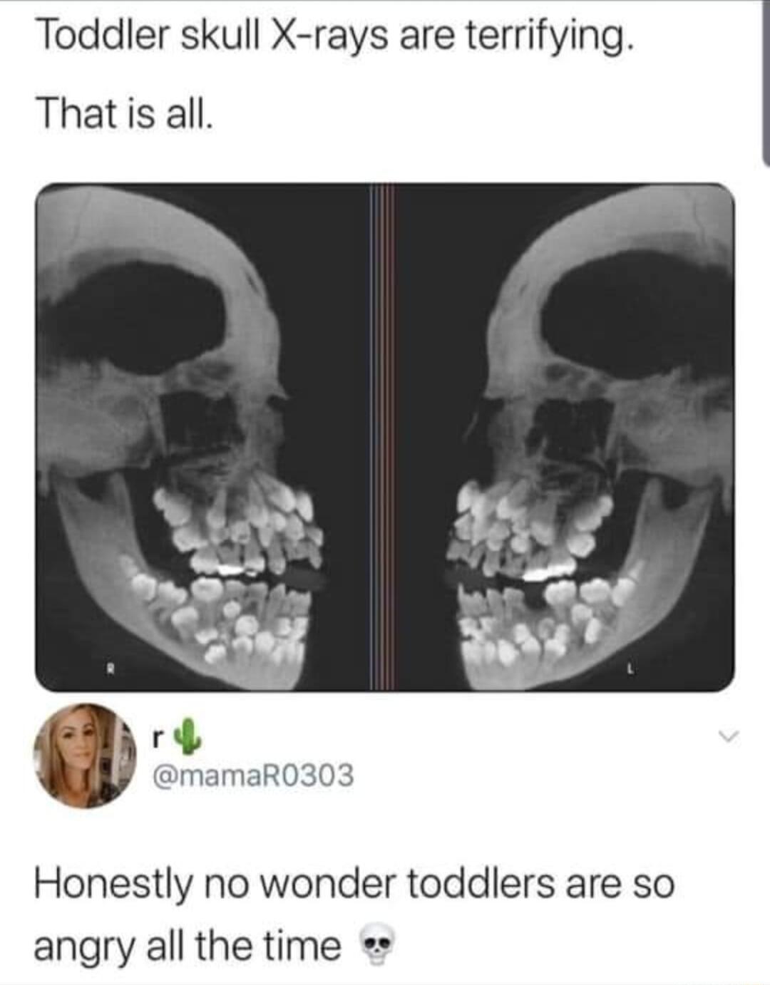 Toddler skull X rays are terrifying Thatis all mamaR0303 Honestly no wonder toddlers are so angry all the time