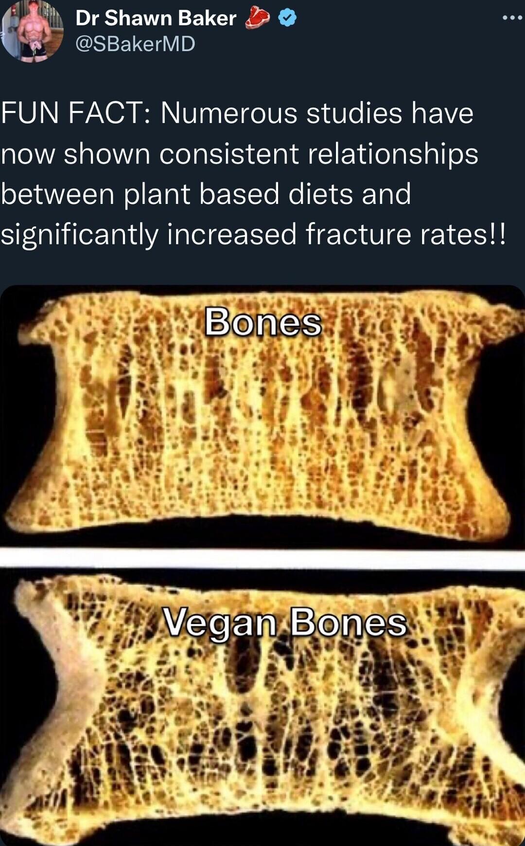Dr Shawn Baker 2 SBakerMD FUN FACT Numerous studies have now shown consistent relationships between plant based diets and significantly increased fracture rates